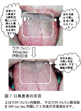 図7口臭患者の舌苔