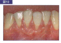 過度なブラッシングによる歯肉退縮。センシティブブラシの適応症例。